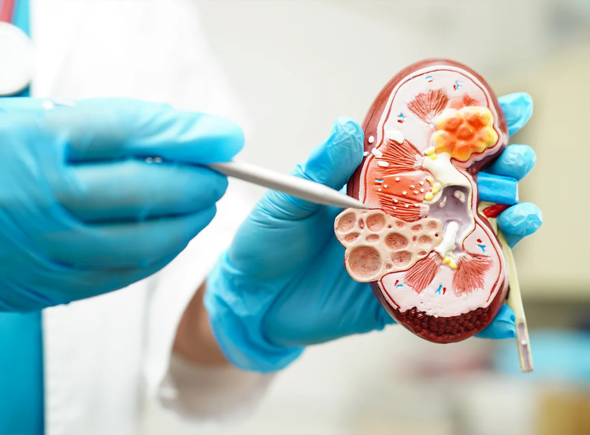 Living with Glomerular Diseases: What You Need to Know